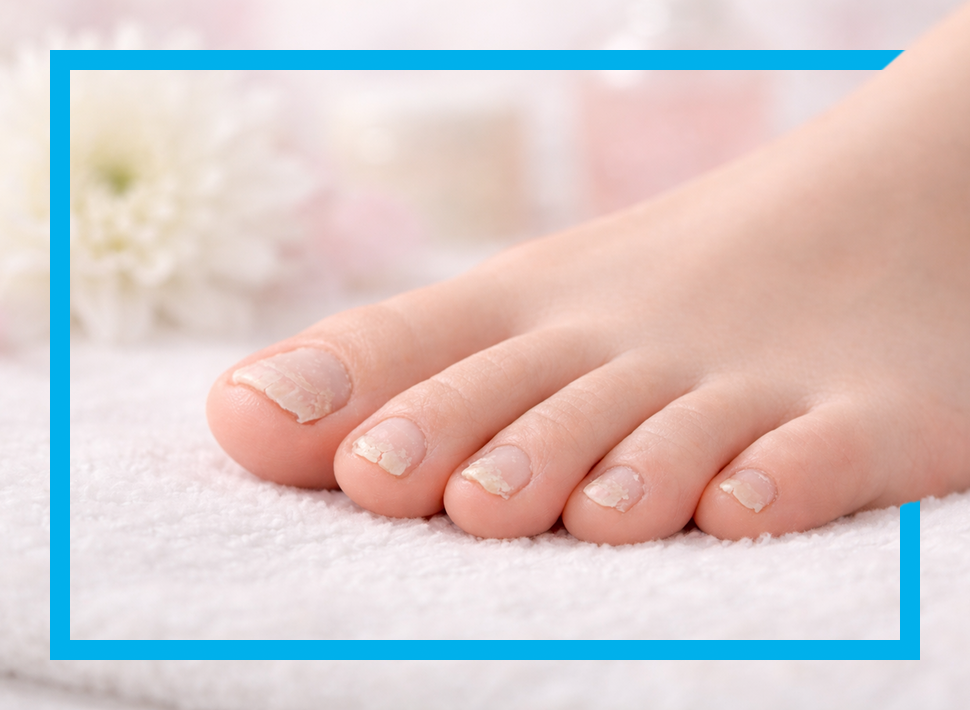 Fuß mit brüchigen Nägeln