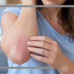 Neurodermitis Schub Pflege und Tipps