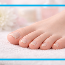 Fuß mit brüchigen Nägeln